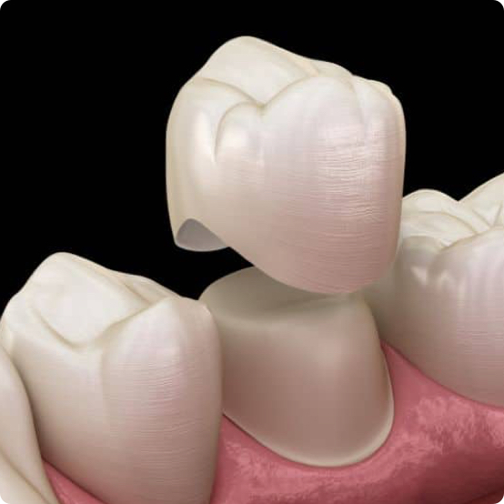 Dental Crowns
