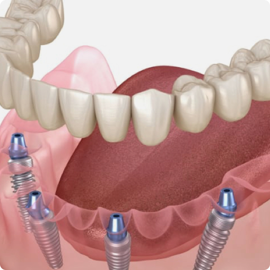 Dental Implants