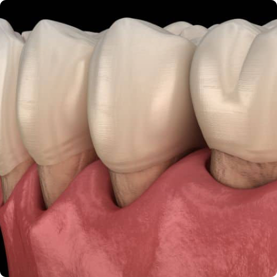 Gum Disease Treatment