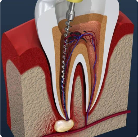 Root Canals