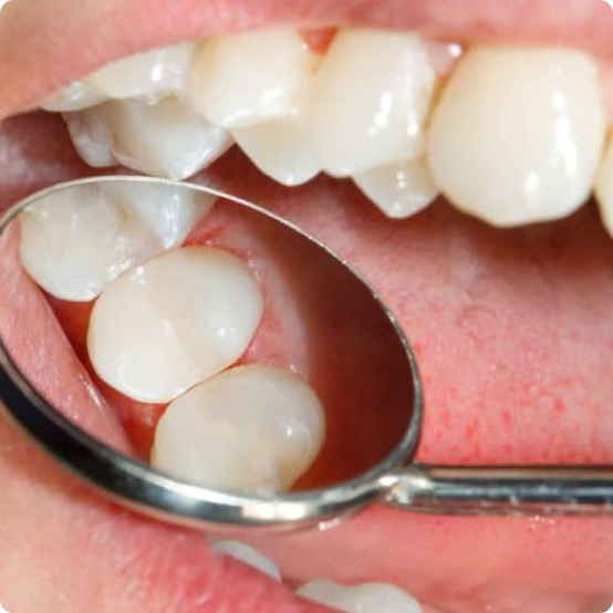 Tooth-Colored Fillings