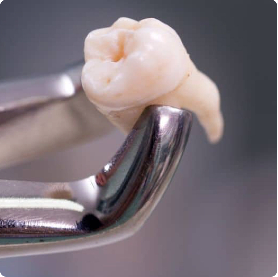 Tooth Extractions