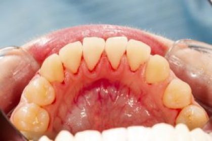 bleeding gums