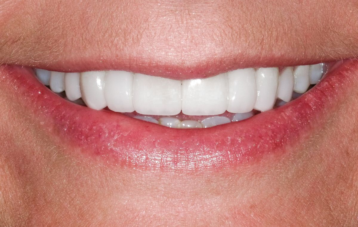 Improving Your Smile With Dental Veneers