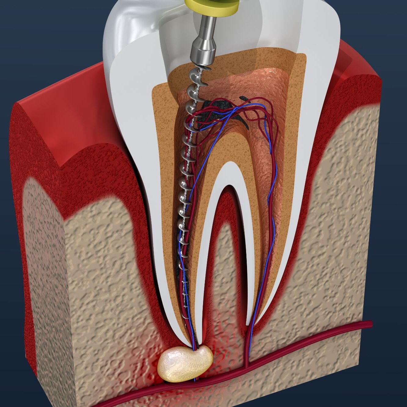 AdobeStock_203366740 Root Canal Plymouth Mn