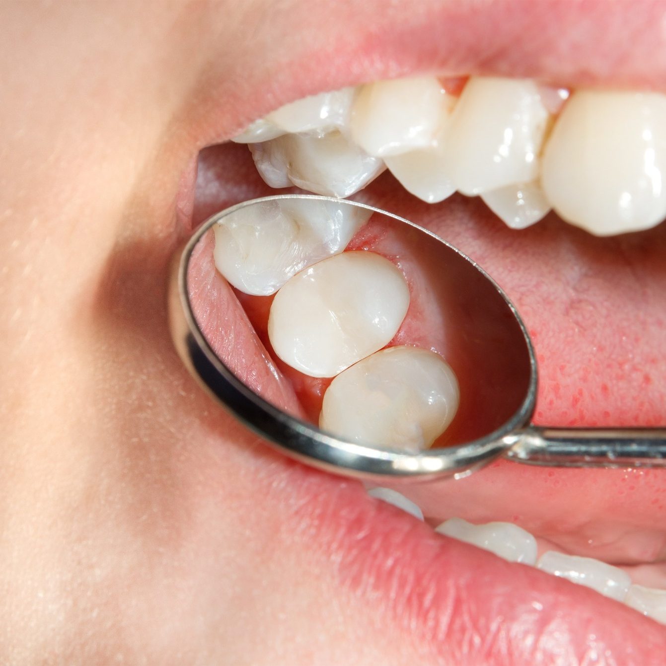 Tooth-colored fillings close up inside someone's mouth